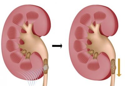  8 خطوات لعلاج حصوات الكلى دون تدخل جراحى
